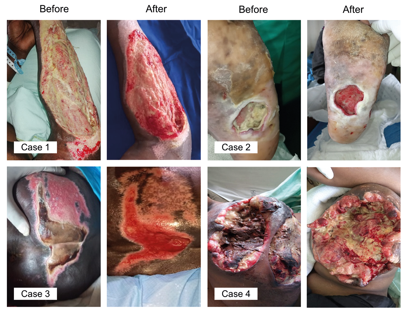 Eight photographs of four wounds treated with maggot therapy in Kenya. For each wound, one image shows the wound before treatment and one after. The caption provides case descriptions.