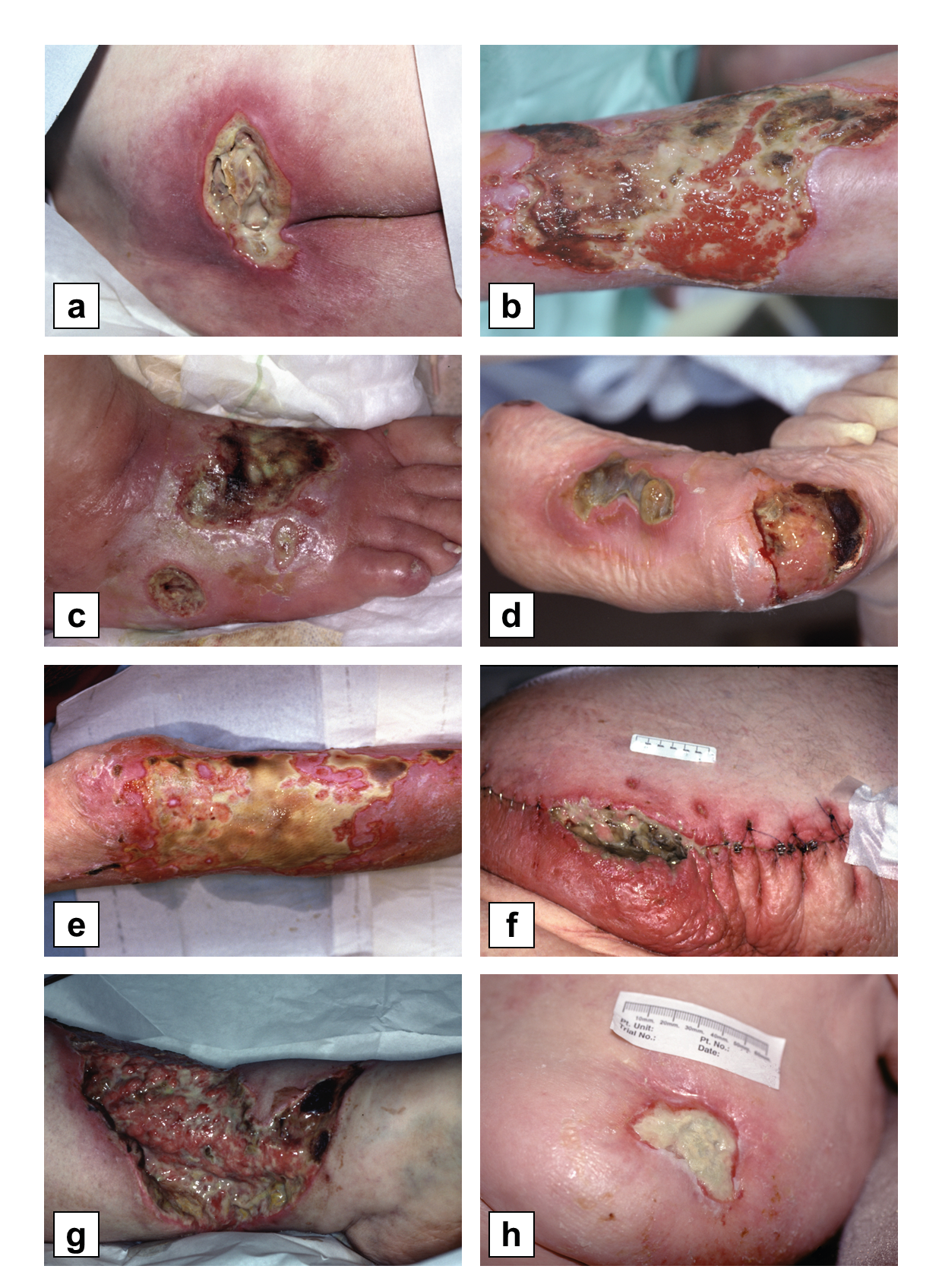 This figure shows eight photographs of chronic wound types that are amenable to maggot therapy. They include a pressure ulcer, a venous stasis ulcer, a diabetic foot ulcer, a burn, surgical wound dehiscence, an orthopaedic wound, and a malignancy.