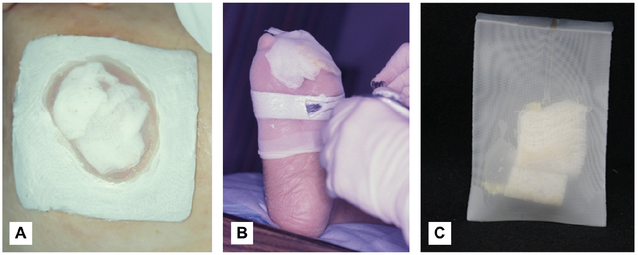 This figure contains three images that show three alternative ways to apply medicinal maggots. Photo A) shows a net dressing applied to a flat body region, Photo B shows a practitioner applying a maggot therapy dressing to a patient's foot to treat a toe woud, and Photo C) is a picture of a biobag used to contain medicinal maggots during treatment. The image shows the small net bag containing foam spacers and some maggots.