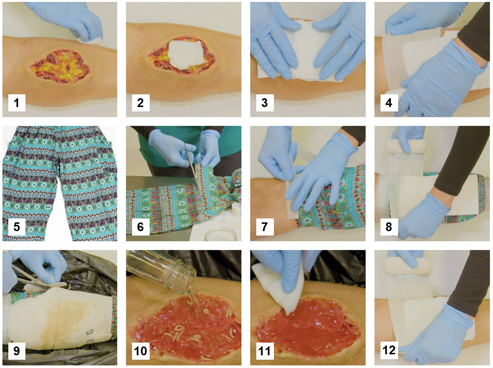 Twelve photographs show step-by-step the process of applying a free-range medicinal maggot dressing when only basic resources for wound care are available. Importantly, the plastic mesh dressing is replaced by ordinary fabric from a pair of cotton pants. The caption provides a detailed verbal description of the process.