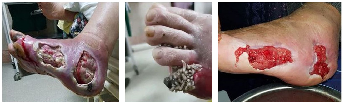 Three before-during-after photographs from a publication by Parizad and colleagues show a diabetic ulcer treated with maggot therapy. The first image depicts the poor state of the untreated wound, the second shows maggots on a toe section of the foot, and the third image shows the derbrided wound with clean granulation tissue after maggot therapy.
